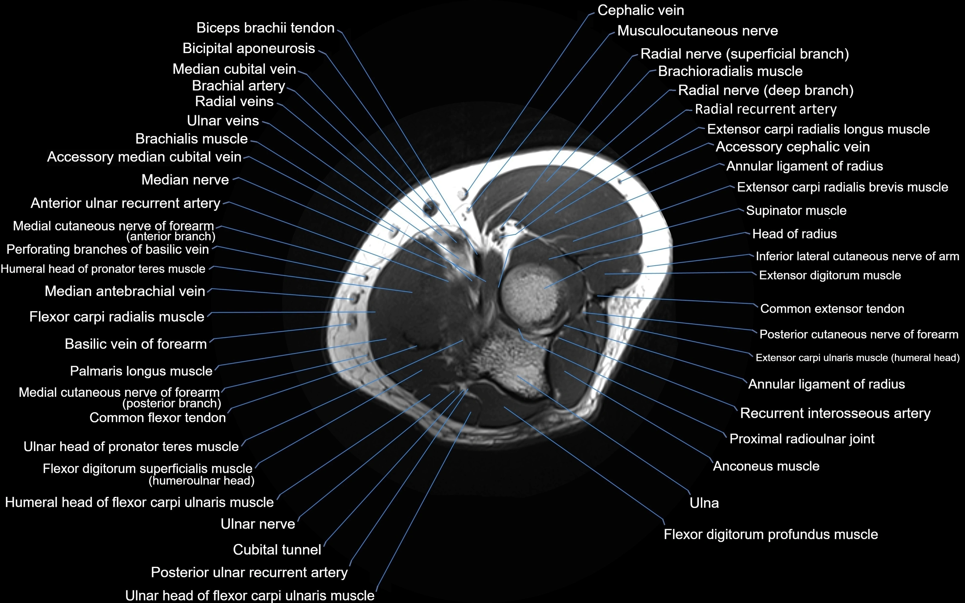 MRI elbow axial cross sectional anatomy 3T  radiology  image-img-00001-00019.webp